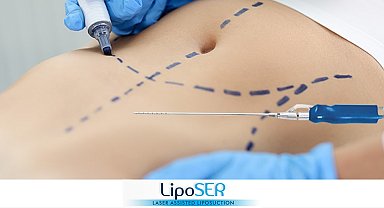 Lazer Destekli Liposer İle Fazla Yağlara Son