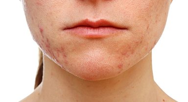 2030 yılında toplumun yüzde 50'si alerjik hasta olabilir