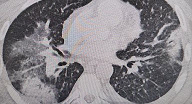 Klimaya bağlı "yaz zatürresine" dikkat