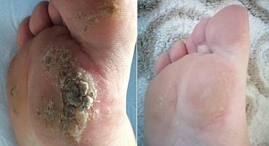 Uzmanlar, ozon tedavisinin farklı hastalıkların tedavisinde iyi sonuçlar verdiğini belirtiyor