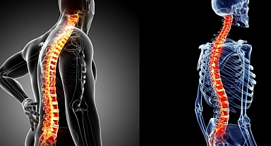 Skolyozda erken teşhis önemli