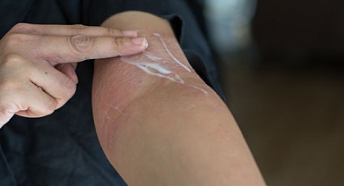 Uyuz hastalığının nedeni hijyen eksikliği