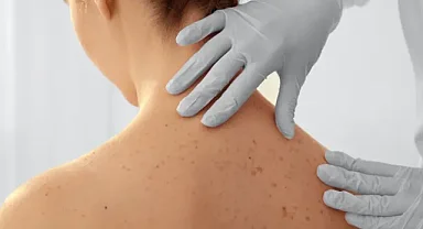 Benlerinizdeki renk değişimi kanser habercisi olabilir