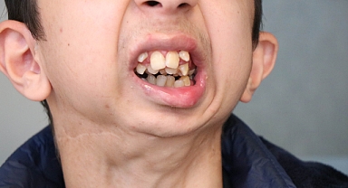 Alt Çenesi Yok, Dişleri Üst Damağında: Ameliyat İçin Yardım Bekliyor 