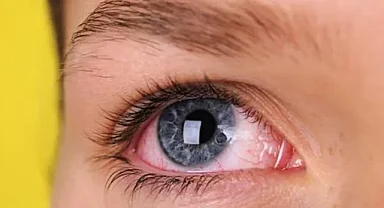 Gözyaşınız akmıyorsa nedeni bağışıklık hastalığı olabilir