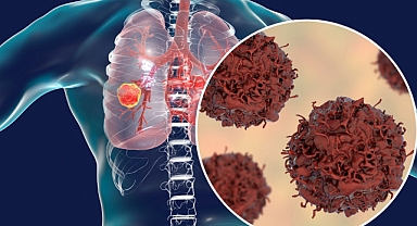Akciğer kanserinin yüzde 90 sebebi sigara