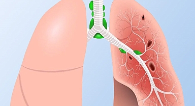 BAÜN Akademisyenlerinden Uluslararası Başarı: Sarkoidozda Yeni Test Yöntemleri