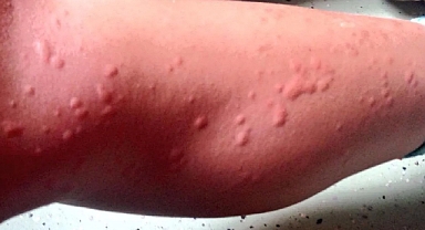 Kumsalda Gizli Tehlike: Uzmanlardan Akrep Sokmasına Karşı Hayati Uyarı!