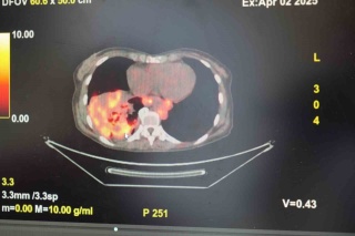 Sigara İçmeyenlerde Artan Akciğer Kanseri Riski